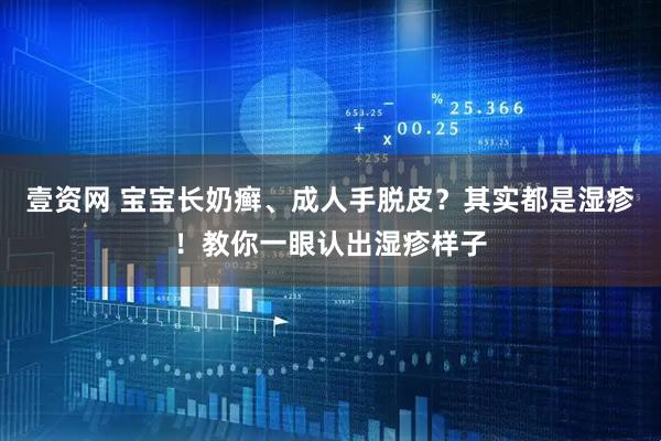 壹资网 宝宝长奶癣、成人手脱皮？其实都是湿疹！教你一眼认出湿疹样子